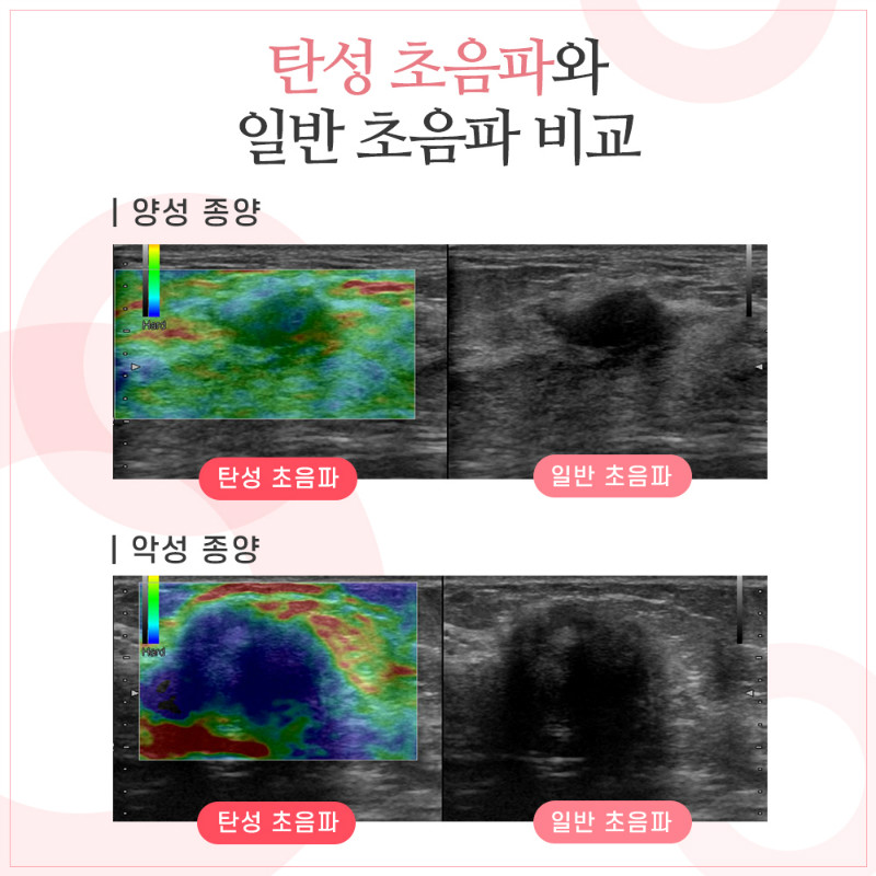 [유방센터] 유방탄성초음파 3.jpg