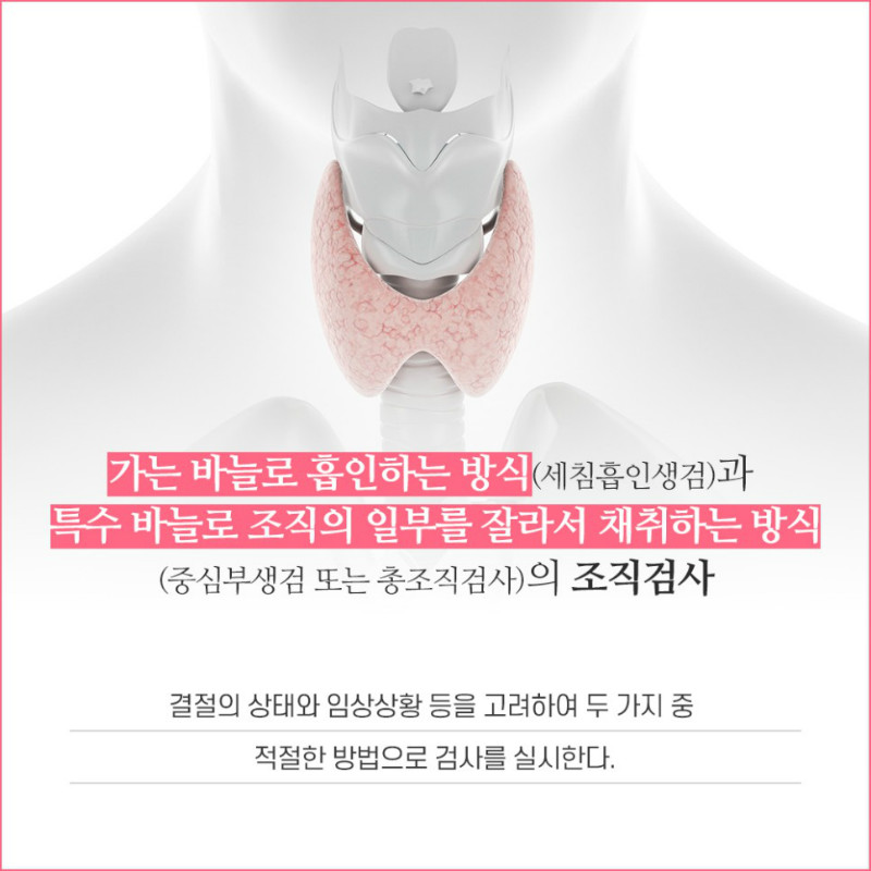 [갑상선센터] 갑상선 결절 5.jpg